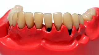 Kunstgebiss, dass Paradontose an Zahnhälsen zeigt (Bild: imago/CHROMORANGE)