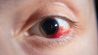 Braunes Auge mit geplatzten Äderchen (Bild: Colourbox)