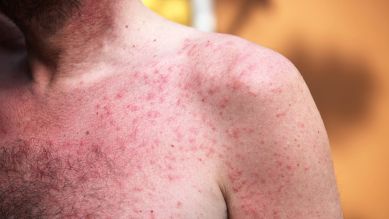 Sonnenallergie Symptome: Mann mit rotem Ausschlag auf Schulter und Brust (Quelle: imago/YAY Images)