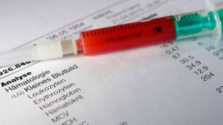 Leberwerte: Bild zeigt Blutprobe auf Auswertung eines Blutbildes (Bild: imago images/CHROMORANGE)