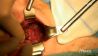 Schilddrüsen-OP Nachgefragt: Die OP-Wunde nach der Entfernung des linken Schilddrüsenlappens