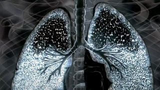 Lunge-Röntgenbild (Quelle: rbb)