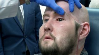 Aaron James hat als erster Mensch weltweit ein Auge transplantiert bekommen