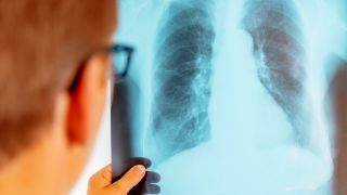 Ein Arzt analysiert ein Lungen-Röntgenbild (Bild: Colourbox)