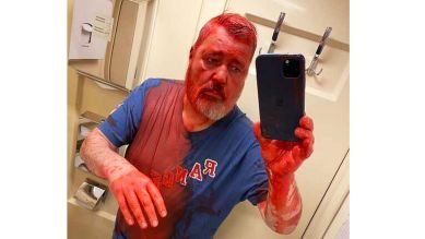 Mit einem Selfie dokumentierte Dmitry Muratow das auf ihn verübte Attentat mit acetonhaltiger Ölfarbe (Bild: SWR/Nowaja Gaseta)