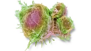 Krebszelle und T Lymphozyten eingefärbt unter dem Elektronenmikroskopes (Quelle: imago/Science Photo Library)