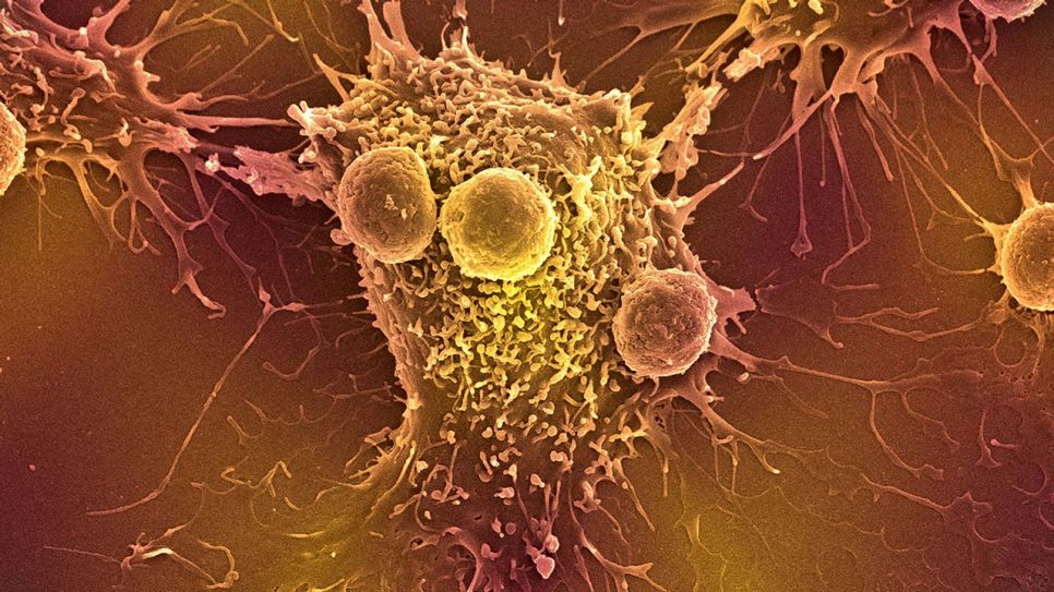 Krebszellen (Quelle: imago/Science Photo Library)