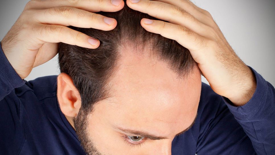 Vorne stirn frau haarausfall Haarausfall bei