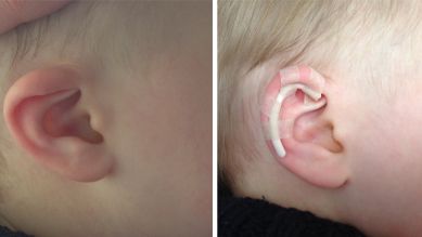 Links: Vor dem nicht-chirurgischen Verfahren, rechts: Fixierung des Ohres mit einem Röhrchen (Quelle: Klinikum Ernst von Bergmann)