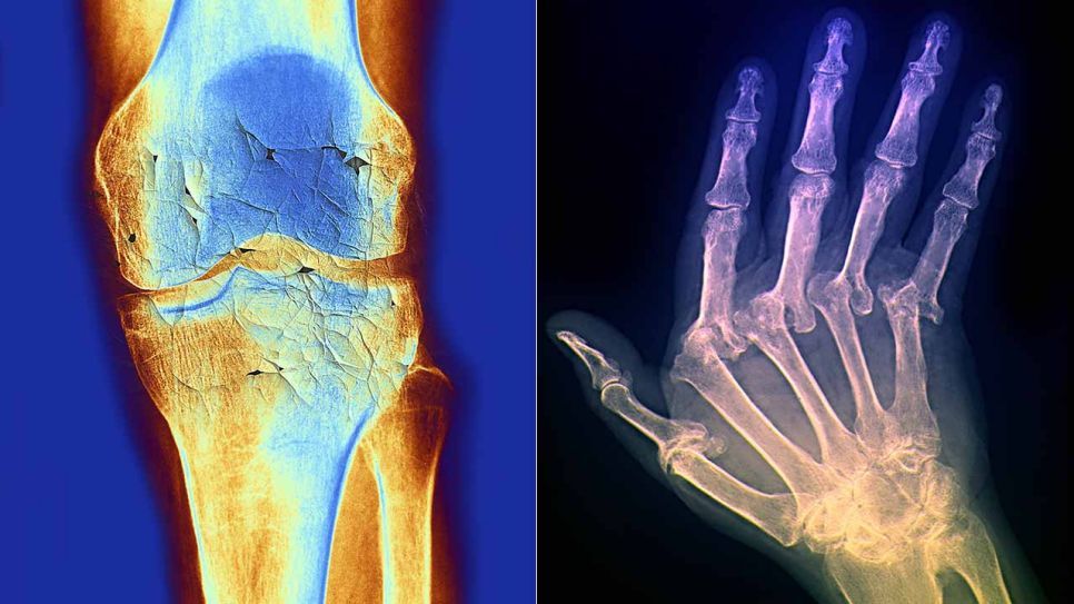 Arthroseabbildung: Knochen auf Knochen (Quelle: imago/Science Photo Library)