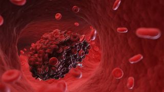 3D-Bild eines Blutgerinsels in einem Gefäß (Bild: imago/Science Photo Library)
