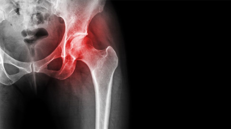 Röntgenbild Hüfte mit rotem Knochen (Bild: Coloubox)