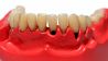 Kunstgebiss, dass Paradontose an Zahnhälsen zeigt (Bild: imago/CHROMORANGE)