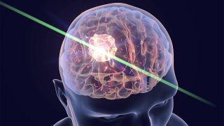 3D-Darstellung eines Gehirns, das mit Laserverfahren therapiert wird (Bild: imago images/Science Photo Library)