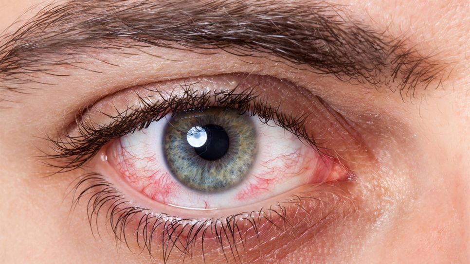 Auge mit Bindehautentzündung (Bild: imago images/CHROMORANGE)