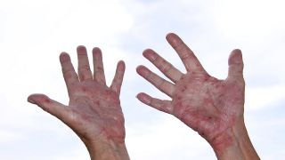 Hände mit Neurodermitissymptomen recken sich gen Himmel (Bild: imago images/imagebroker)