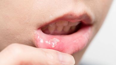 Bläschen im mund durchsichtiges Herpes im