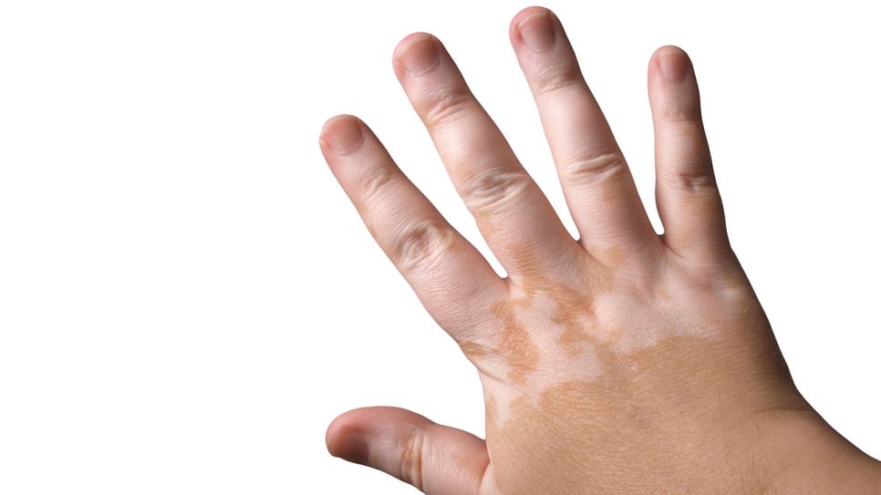 Weiße Pigmentflecken an einer Hand (Bild: imago images/Shotshop)