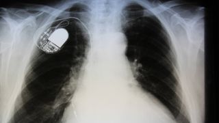 Röntgenbild eines Herzschrittmachers (Bild: imago images/CHROMORANGE)