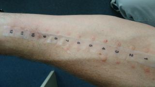 Allergietest am Unterarm (Bild: Colourbox)