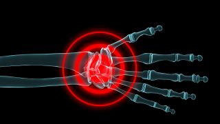 Schmerzen in der Handfläche symbolisiert durch rote Kreise (Quelle: imago/PantherMedia / Sebastian Kaulitzki)