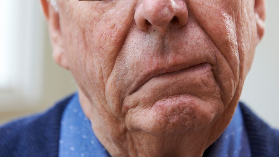 Halbseitige Gesichtslähmung bei älterem Mann (Bild: imago/agefotostock)