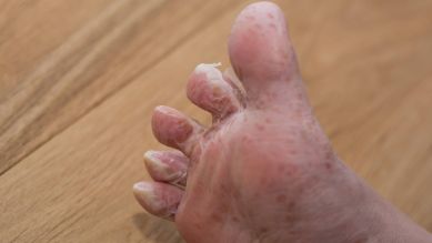 Hand-Mund-Fuß-Krankheit: Fuß häutet sich nach der Krankheit (Quelle: imago/CHROMORANGE)