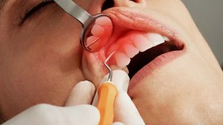 Parodontitis: Untersuchung am Zahnfleisch eines Mannes (Bild: unsplash/Caroline Im)