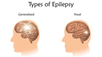 Epilepsieformen: Grafik zeigt generalisierte Form und fokale Form der Epilepsie (Quelle: imago/Science Photo Library)imago/)
