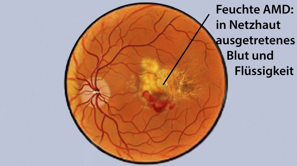 Feuchte Makuladegeneration: Grafik zeigt in Netzhaut ausgetretenes Blut und Flüssigkeit (Quelle: imago/StockTrek Images)