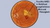 Feuchte Makuladegeneration: Grafik zeigt in Netzhaut ausgetretenes Blut und Flüssigkeit (Quelle: imago/StockTrek Images)