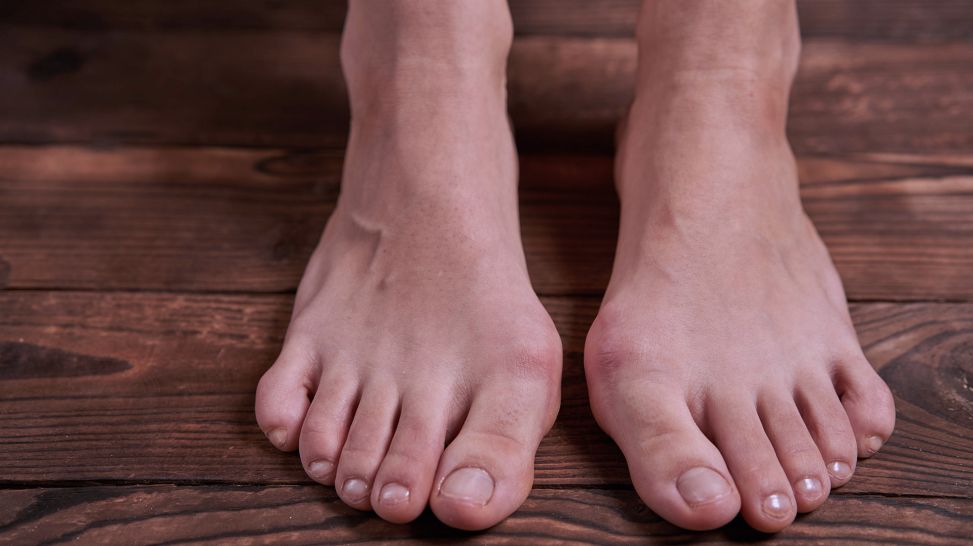 Hallux rigidus: Füße mit Fehlstellung der Großzehen auf Holzboden (Bild: imago/YAY images)