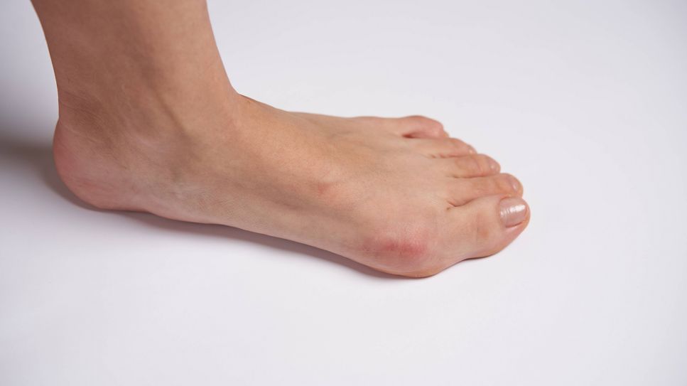 Hallux valgus: Fuß mit ausgeprägtem Zehengrundgelenk von Seite (Bild: imago/YAY Images)
