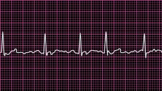 EKG zeigt Vorhofflimmern (Quelle: imago/imagebroker/saurer)
