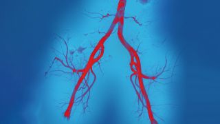Arteriosklerose: Angiografie von Arterien (Bild: imago images/Science Photo Library)
