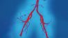 Arteriosklerose: Angiografie von Arterien (Bild: imago images/Science Photo Library)