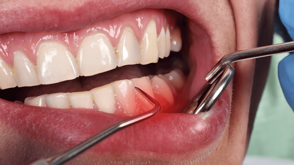 Zahnfleischentzündung: Bild zeigt zahnmedizinische Untersuchung von Zahnfleisch und Zahnhälsen (Bild: Colourbox)