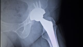 Hüft-OP: Bild zeigt Röntgenbild einer Hüfte mit Gelenk-Prothese (Bild: Colourbox)