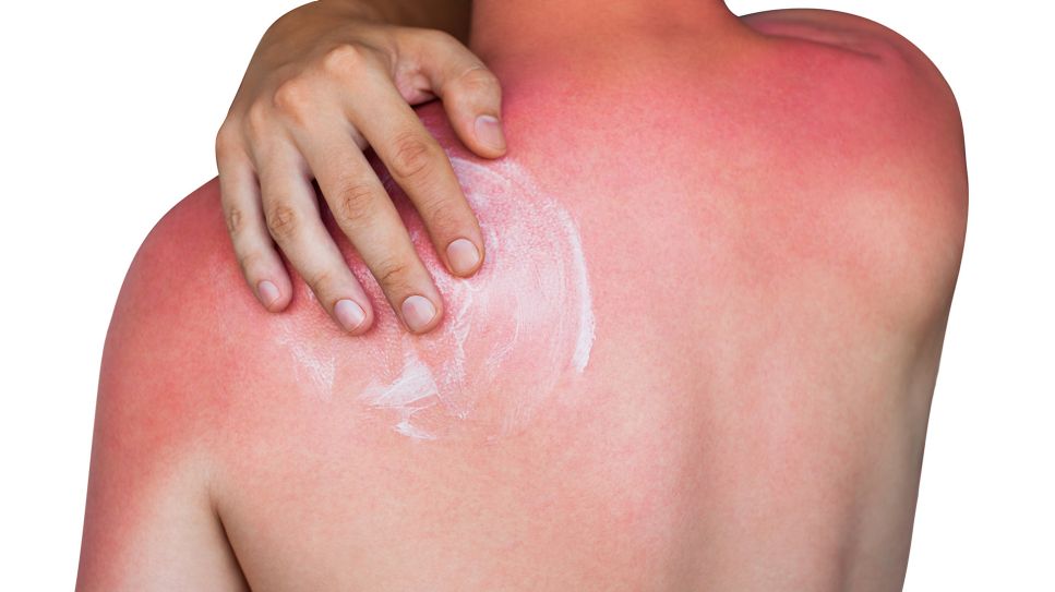 Sonnenbrand: Bild zeigt Mann mit Sonnenbrand auf Schultern und Rücken (Bild: Colourbox)