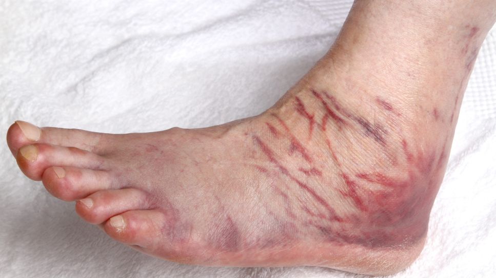 Bänderriss: Bild zeigt geschwollenen Fuß mit großem Bluterguss (Quelle: imago images / Heike Brauer)