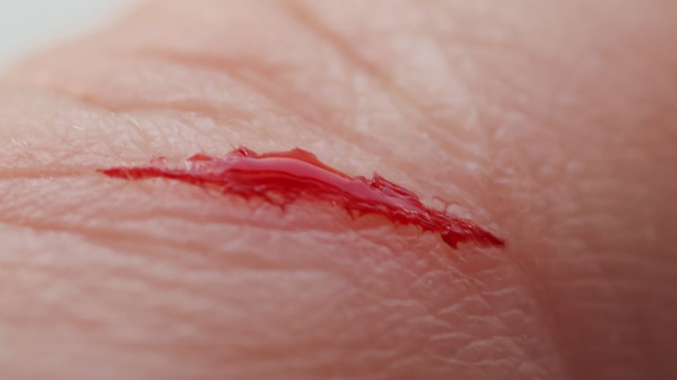 Sepsis (Blutvergiftung): Bild zeigt blutende Wunde am Finger (Bild: Colourbox)