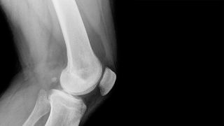 Osteoporose: Bild zeigt Röntgenbild eines Kniegelenkes (Bild: Colourbox)