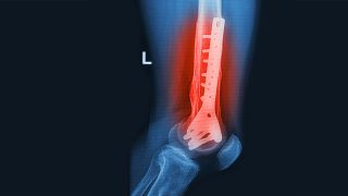 Metall nach Knochenbruch entfernen: Bild zeigt Röntgenbild eines Beins mit Metallplatte am Knochen (Bild: Colourbox)
