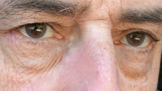Tränensäcke: Bild zeigt Augenpartie mit Schwellungen und erschlaffter Haut in Augenpartie eines Mannes (Bild: imago images/Gottfried Czepluch)
