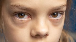 Bindehautentzündung beim Kind: Bild zeigt Mädchen mit roten Augen und Verklebungen an Wimpern und Augenlidern (Bild: imago images/Panthermedia)