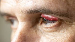 Gerstenkorn: Bild zeigt Mann mit Entzündung der Innenseite und Außenseite des Augenlids (Bild: imago images/Jochen Tack)