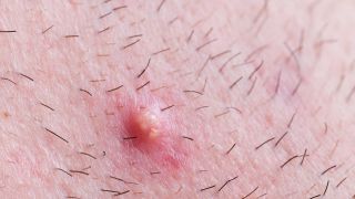 Akne inversa: Pickelartiger Knoten auf rasierter Haut (Bild: Imago Images/YAY Images/Scott Dumas)