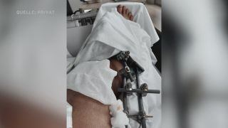 Verletztes Bein nach Mopedunfall (Quelle: privat)
